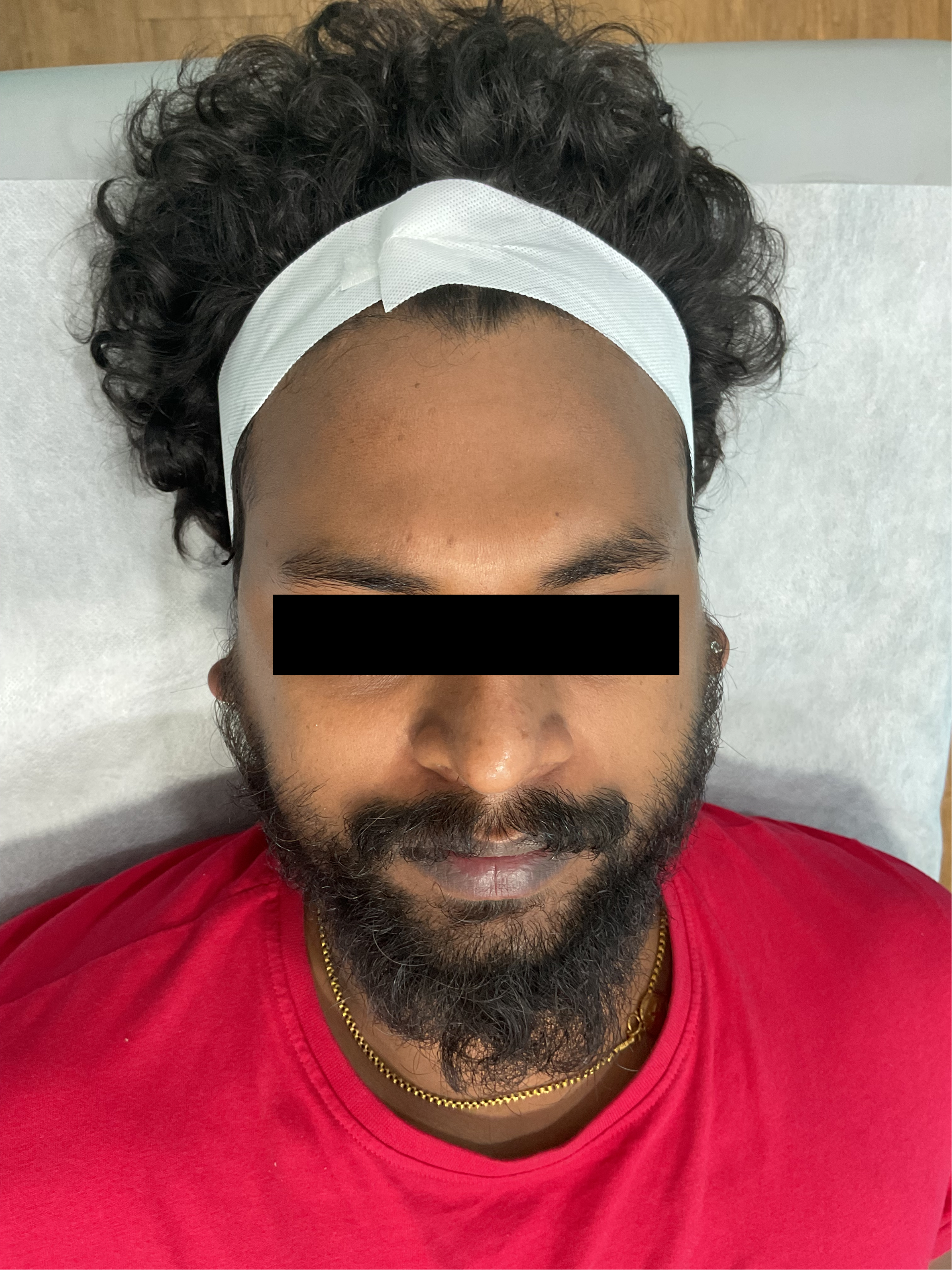 After Acne Treatment